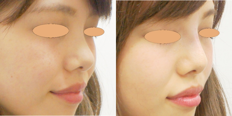 鼻のヒアルロン酸の症例写真