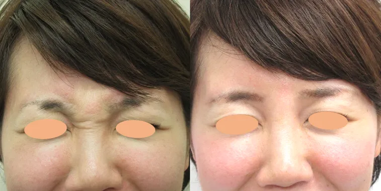 しわ取り注射