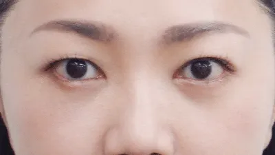 術後14