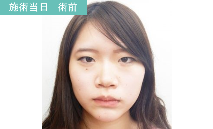 二重埋没法