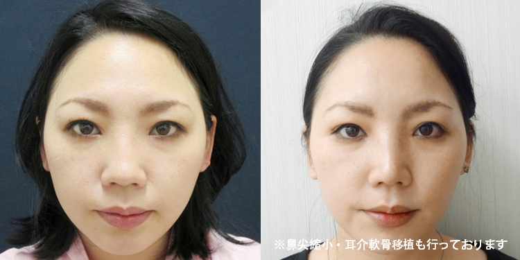鼻の整形の整形 施術一覧 名古屋院 美容整形なら水の森美容外科 公式