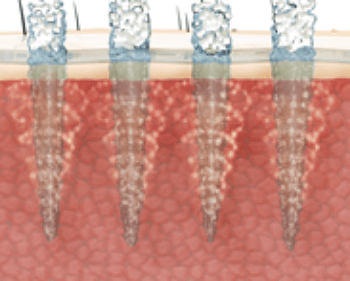 マイクロニードルによるコラーゲン生成イメージ