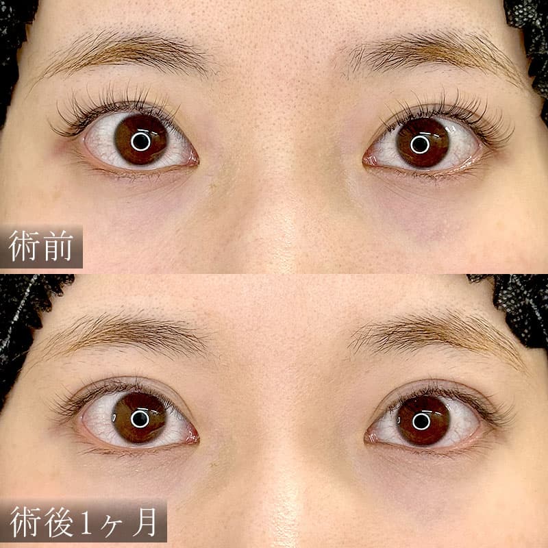 自然癒着法の症例写真