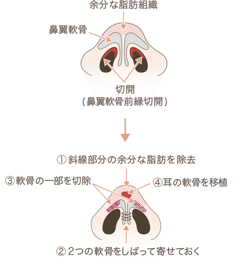 鼻の解剖と施術方法