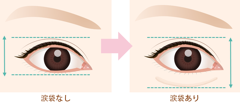名古屋院の 涙袋ヒアルロン酸注入 の効果