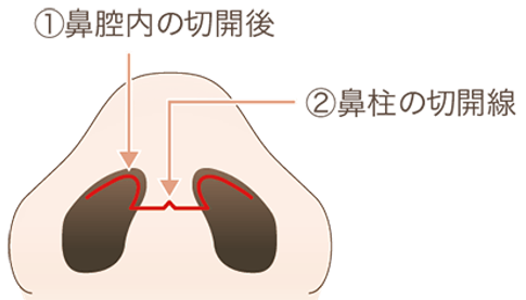 わし鼻修正の手術方法1