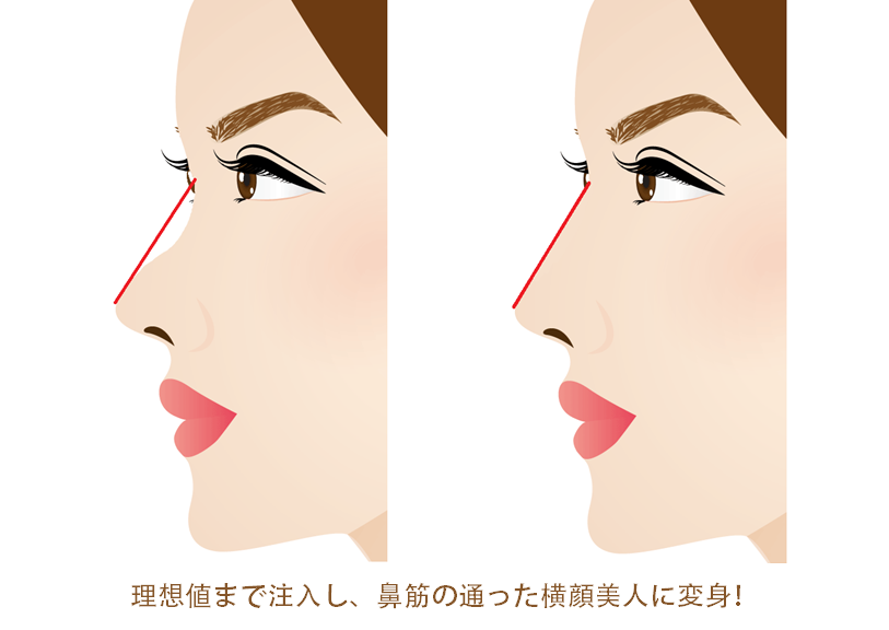 鼻のヒアルロン酸の効果