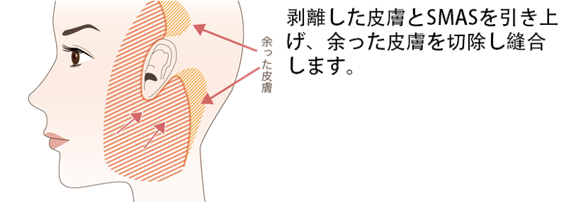 フェイスリフトの手術方法とポイント③余った皮膚の切除＆縫合を行う剥離した皮膚とＳＭＡＳを引き上げ、余った皮膚を切除し縫合します。